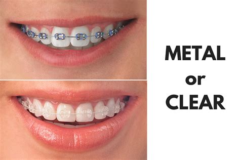 clear brackets vs metal brackets braces|metal braces vs clear aligners.